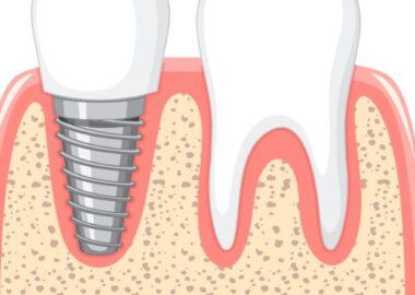 gennemgang af implantatbehandling